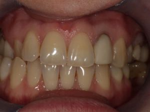 korony-i-mosty-cyrkonowe-1a