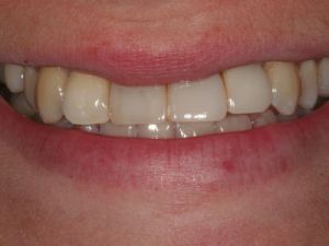 korony-i-mosty-cyrkonowe-2a