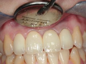 korony-i-mosty-cyrkonowe-2b