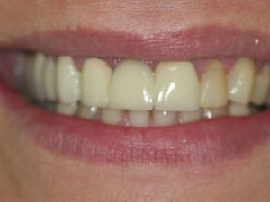 korony-i-mosty-cyrkonowe-3a