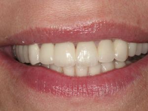 korony-i-mosty-cyrkonowe-3b