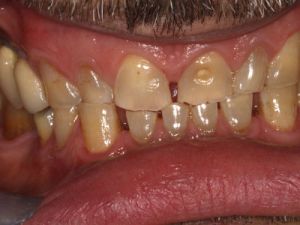 korony-i-mosty-cyrkonowe-4a