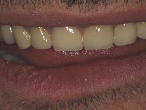 korony-i-mosty-cyrkonowe-4c