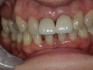 korony-i-mosty-cyrkonowe-5a