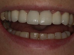 korony-i-mosty-cyrkonowe-5b