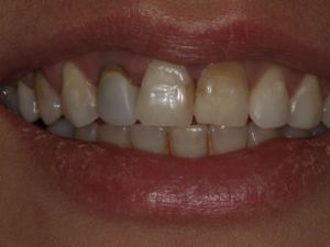 korony-i-mosty-cyrkonowe-6a