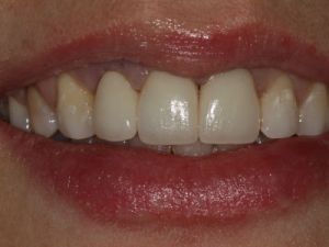 korony-i-mosty-cyrkonowe-6b