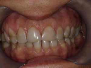 korony-i-mosty-cyrkonowe-7a