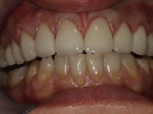 korony-i-mosty-cyrkonowe-7b