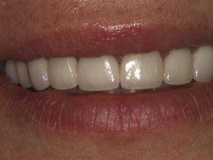 korony-i-mosty-cyrkonowe-7c