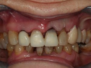 korony-i-mosty-na-metalu-1a