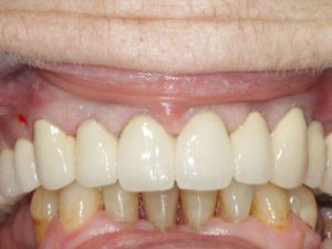 korony-i-mosty-na-metalu-1b