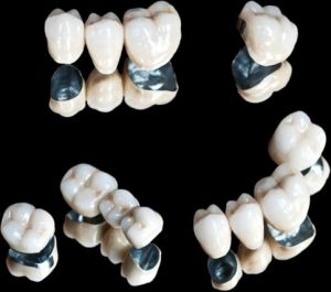 korony-metalowe-z-ceramiką