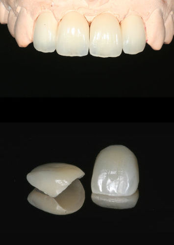 korony-pełnoceramiczne