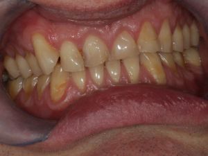 licowki-i-korony-pelnoceramiczne-1a