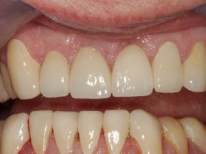 licowki-i-korony-pelnoceramiczne-1b