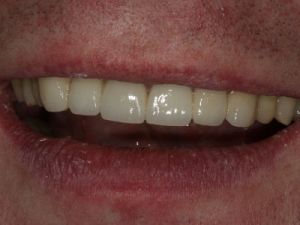 licowki-i-korony-pelnoceramiczne-1c