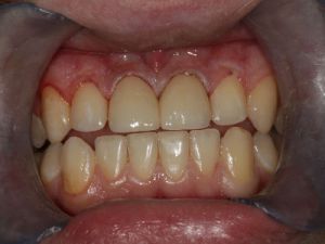 licowki-i-korony-pelnoceramiczne-2b