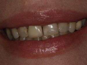 licowki-i-korony-pelnoceramiczne-3a