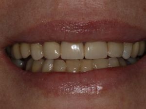 licowki-i-korony-pelnoceramiczne-3b