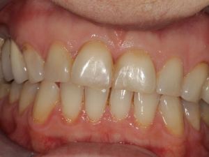 licowki-i-korony-pelnoceramiczne-4a