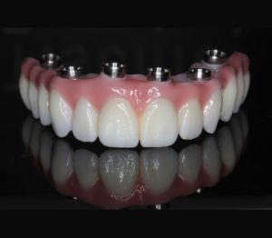 mosty-korony-protezy-na-implantach