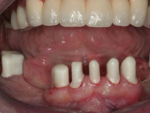 prace-kombinowane-na-koronach-teleskopowych-1a