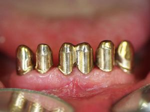 prace-kombinowane-na-koronach-teleskopowych-2a