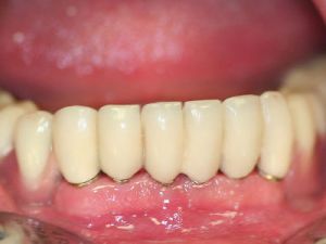 prace-kombinowane-na-koronach-teleskopowych-2b