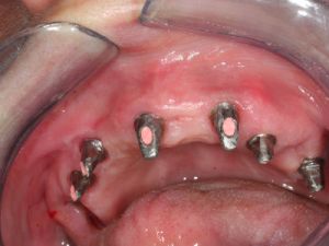 uzupelnienie-bezzebia-mostem-na-implantach-1a