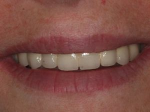 uzupelnienie-bezzebia-mostem-na-implantach-1c