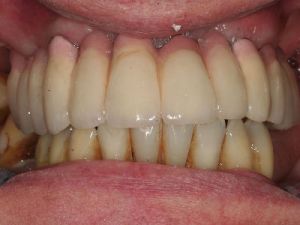 uzupelnienie-bezzebia-mostem-na-implantach-2a