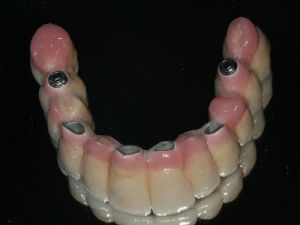 uzupelnienie-bezzebia-mostem-na-implantach-2b