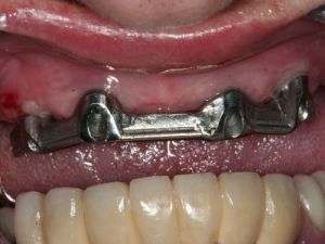 uzupelnienie-bezzebia-proteza-na-belce-na-implantach-1a