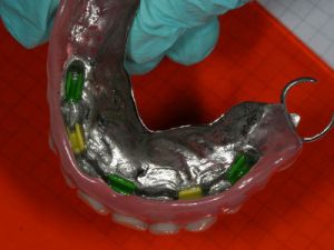 uzupelnienie-bezzebia-proteza-na-belce-na-implantach-1b