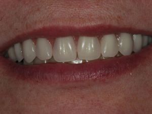 uzupelnienie-bezzebia-proteza-na-belce-na-implantach-1c