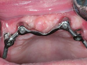 uzupelnienie-bezzebia-proteza-na-belce-na-implantach-2a
