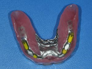 uzupelnienie-bezzebia-proteza-na-belce-na-implantach-2b