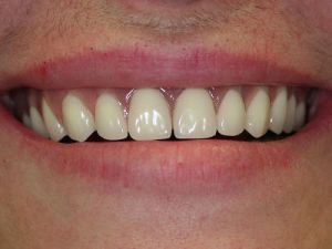 uzupelnienie-bezzebia-proteza-na-belce-na-implantach-2c