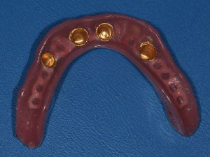 uzupelnienie-bezzebia-proteza-na-koronach-teleskopowych-na-implantach-1a