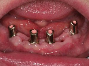 uzupelnienie-bezzebia-proteza-na-koronach-teleskopowych-na-implantach-1b