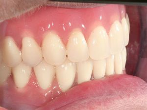 uzupelnienie-bezzebia-proteza-na-koronach-teleskopowych-na-implantach-1c