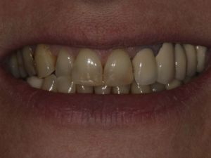 uzupelnienie-brakow-czesciowych-mostem-na-implantach-przyklad1a