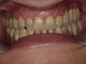 uzupelnienie-brakow-czesciowych-mostem-na-implantach-przyklad1b