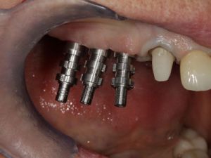 uzupelnienie-brakow-czesciowych-mostem-na-implantach-przyklad2a