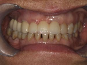 uzupelnienie-brakow-czesciowych-mostem-na-implantach-przyklad2b