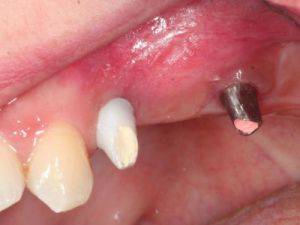 uzupelnienie-brakow-czesciowych-mostem-na-implantach-przyklad3a