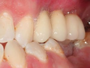 uzupelnienie-brakow-czesciowych-mostem-na-implantach-przyklad3b